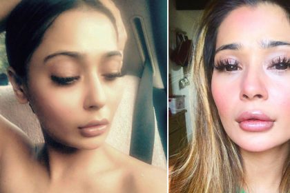 Sara Khan lip job done goes wrong