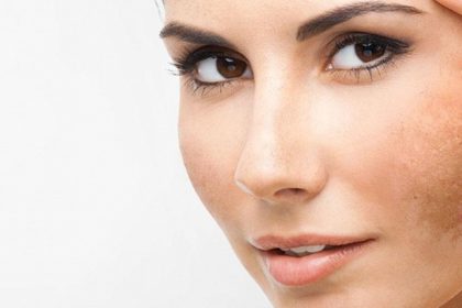 Home Remedies For Pigmentation