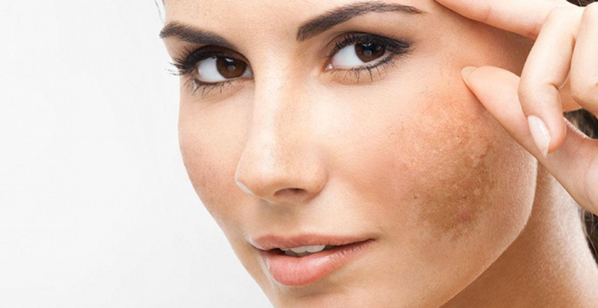 Skin Care Tips: झाइयों की परेशानी होगी हमेशा के लिए खत्म, अपनाएं ये 5 चमत्कारी घरेलू नुस्खे