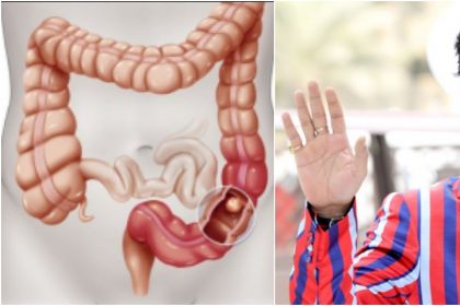 Colon Infection: इरफान खान को हुआ था कोलोन इंफेक्शन, जानिए इस बीमारी के बारे में सब कुछ