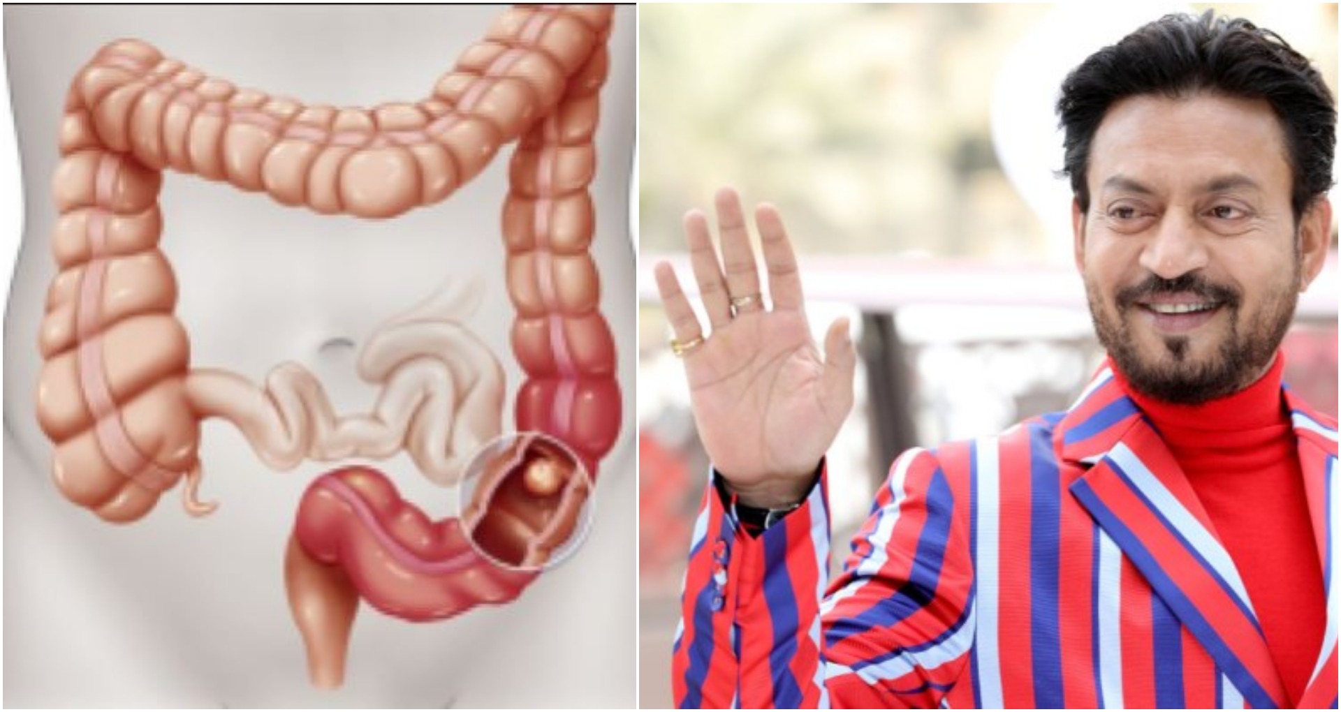 Colon Infection: इरफान खान को हुआ था कोलोन इंफेक्शन, जानिए इस बीमारी के बारे में सब कुछ